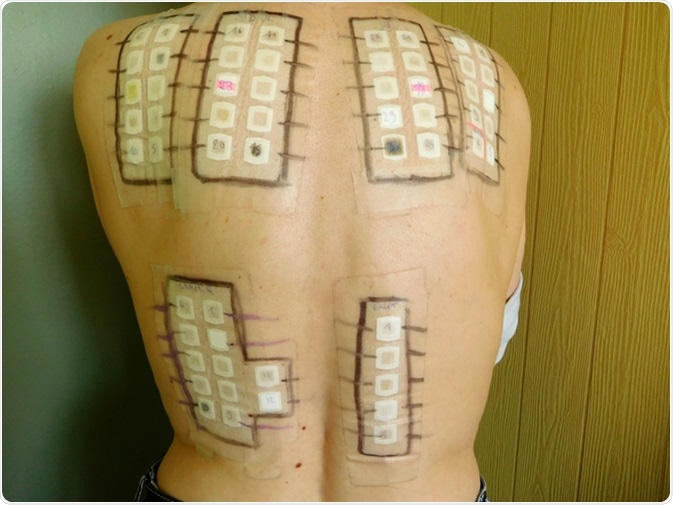 Epicutaneous allergy test on the skin of the back. Image Credit: Jessi et Nono / Shutterstock